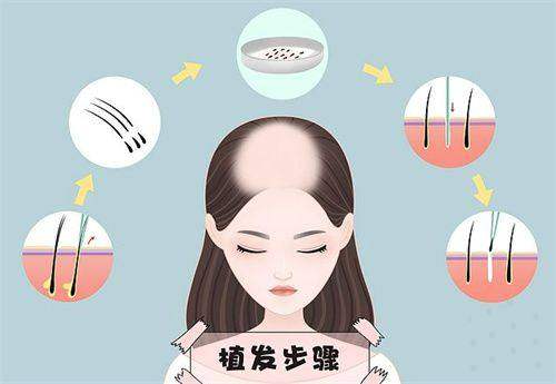 长沙市开福区碧莲盛医疗美容门诊曹国荣毛发移植多少钱：SHT无痕植发12元/毛囊单位，BHT立体加密微针植发18元/毛囊单位