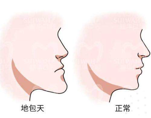 镇雄韩美口腔张胜军医生地包天矫正：原价12800元起，现优惠价低至7999元起！