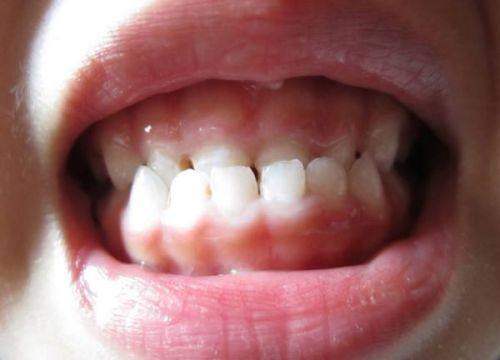 儿童早期地包天干预:功能性矫治器,引导骨骼发育