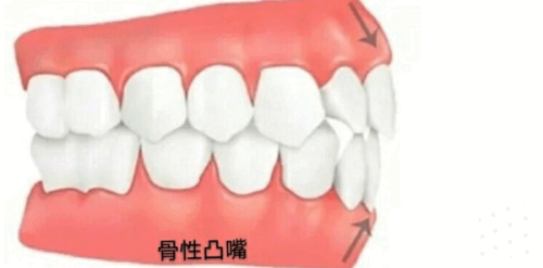 漯河众植口腔刘世博医生根管治疗：原价1500元起，现优惠价低至880元起！