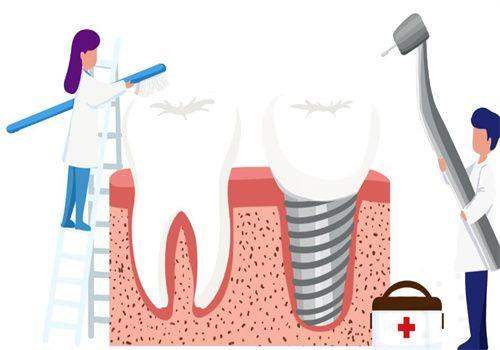 半口/全口种植牙:All-on-4/6技术,效率高重建