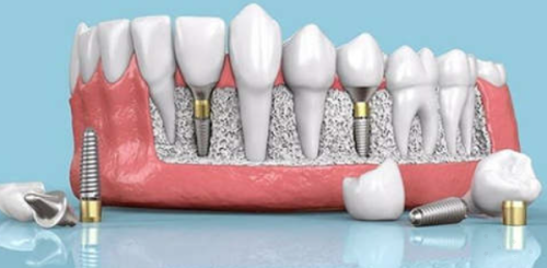 多颗种植牙:分段种植,稳固耐用