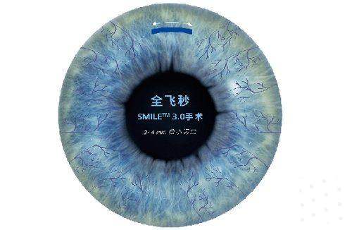 扬州爱尔眼科医院庄朝荣做全飞秒激光多少钱，价格16000 - 23000元受多因素影响