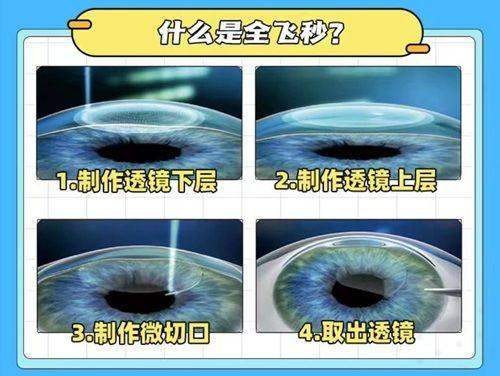 扬州爱尔庄朝荣全飞秒日记：告别眼镜的72小时蜕变