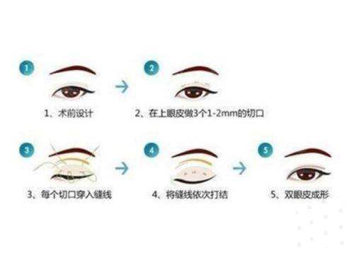 晋安白天鹅医疗美容门诊部林祥医生眼部整形价格：韩风双眼皮20253元起