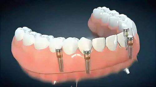 镇雄缺牙患者的重生之旅：郑立军医生种植牙拯救记