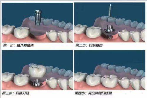 多颗种植牙:分段种植,稳固耐用