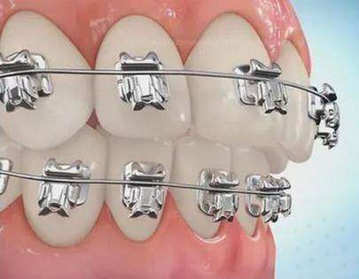 金属自锁托槽美学牙齿矫正:技术成熟,性价比之选