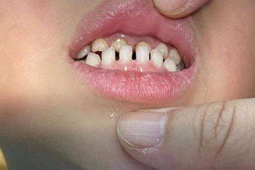 青少年地包天矫正:固定/隐形矫正,兼顾成效与美观