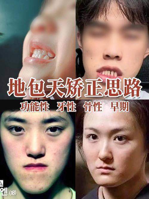 成人地包天矫正:复杂分型矫正,攻克骨性难题