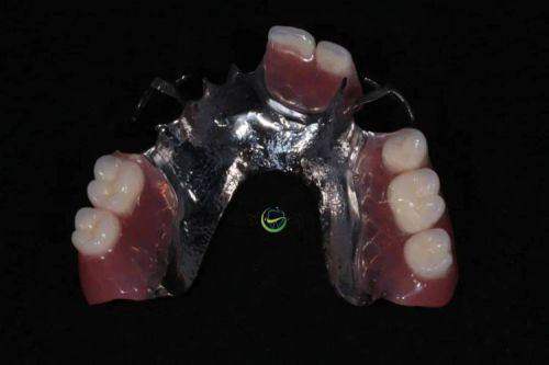 金属基托活动义齿:稳固耐用升级