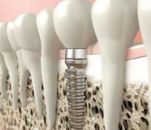 牙齿正畸项目科普